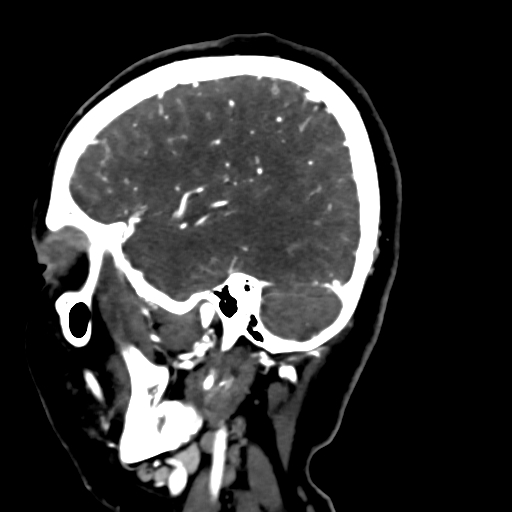 Cerebral arteriovenous malformation (Radiopaedia 73830-84645 Sagittal C+ delayed 72).jpg