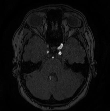 Cerebral arteriovenous malformation (Radiopaedia 74411-85654 Axial MRA 28).jpg