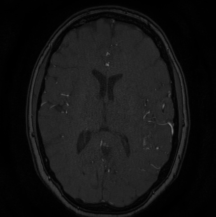 Cerebral arteriovenous malformation (Radiopaedia 74411-85654 Axial MRA 86).jpg