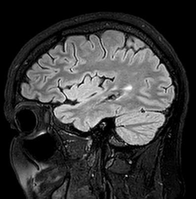 File:Cerebral arteriovenous malformation (Radiopaedia 74411-85746 Sagittal FLAIR 26).jpg
