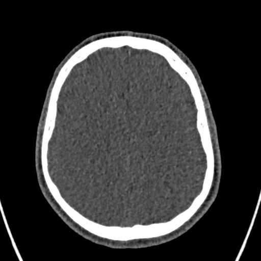 Cerebral arteriovenous malformation (Radiopaedia 78188-90746 Axial non-contrast 129).jpg