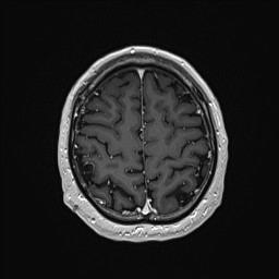 Cerebral arteriovenous malformation (Radiopaedia 84015-99245 Axial T1 C+ 126).jpg