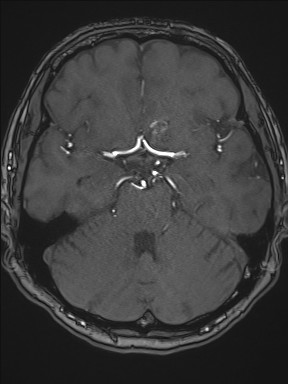 Cerebral arteriovenous malformation (Radiopaedia 84015-99245 Axial TOF 98).jpg