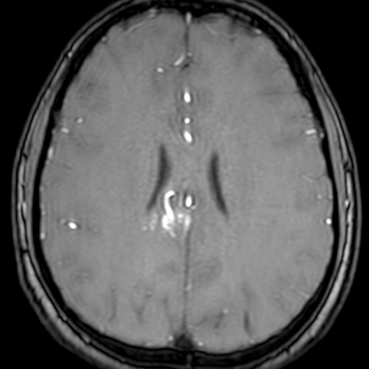 Cerebral arteriovenous malformation at posterior body of corpus callosum (Radiopaedia 74111-84925 Axial MRA 143).jpg
