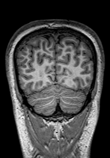 Cerebral arteriovenous malformation at posterior body of corpus callosum (Radiopaedia 74111-84925 Coronal T1 296).jpg