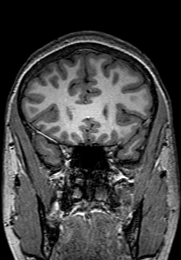 File:Cerebral arteriovenous malformation at posterior body of corpus callosum (Radiopaedia 74111-84925 Coronal T1 83).jpg