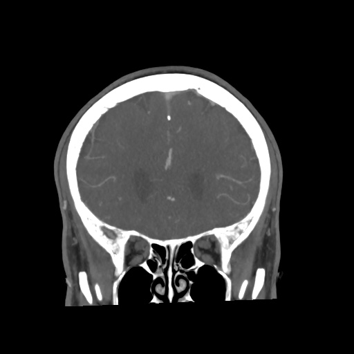 Cerebral arteriovenous malformation with lobar hemorrhage (Radiopaedia 35598-57216 C 28).jpg