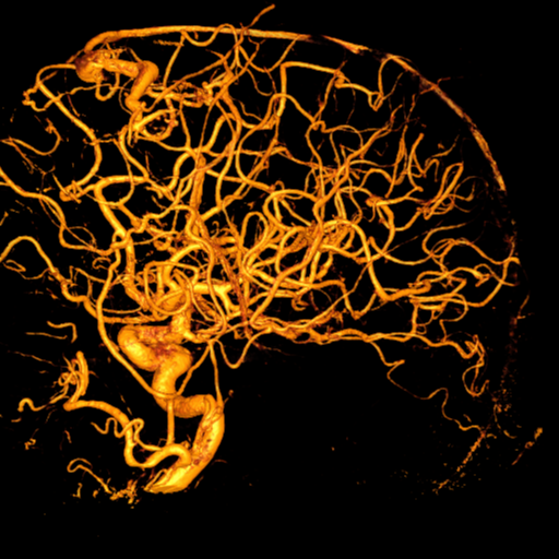 Cerebral arteriovenous malformation with lobar hemorrhage (Radiopaedia 44725-48513 Lateral 56).png
