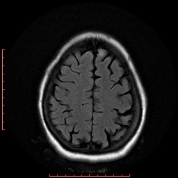 File:Cerebral cavernous malformation (Radiopaedia 26177-26306 FLAIR 17).jpg