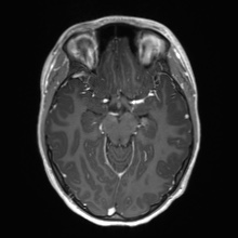 Cerebral cavernous venous malformation (Radiopaedia 70008-80021 Axial T1 C+ 28).jpg