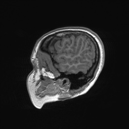File:Cerebral cavernous venous malformation (Radiopaedia 70008-80021 Sagittal T1 66).jpg