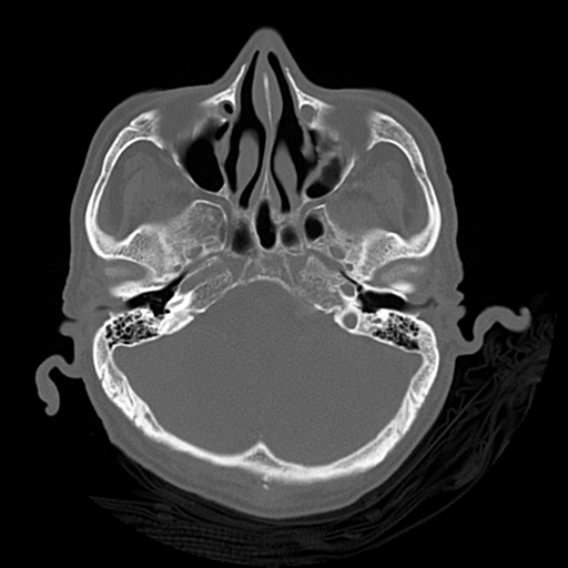 Cerebral contusions, subarachnoid hemorrhage and subdural hygromas (Radiopaedia 55399-61827 Axial bone window 12).png