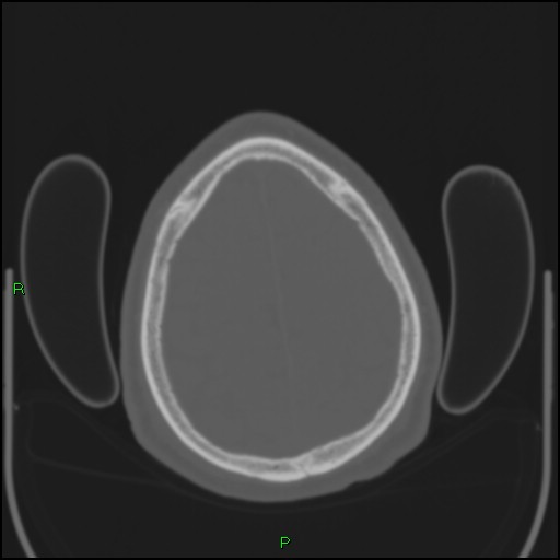 Cerebral contusions (Radiopaedia 33868-35039 Axial bone window 183).jpg