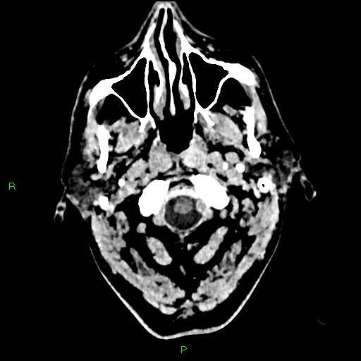 Cerebral contusions (Radiopaedia 33868-35039 Axial non-contrast 1).jpg