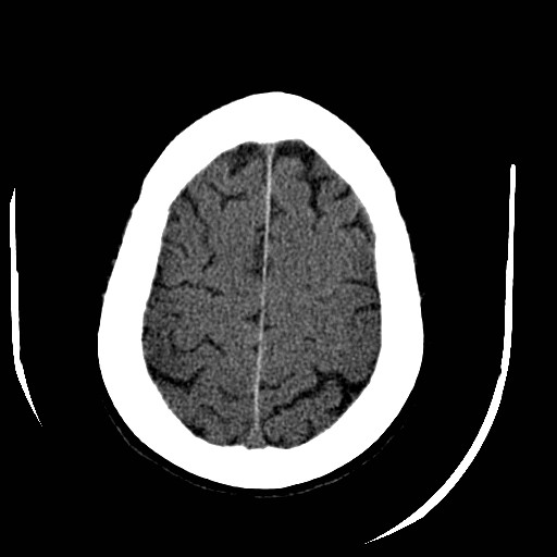 Cerebral edema (evolution in time) (Radiopaedia 19418-19440 non-contrast 78).jpg