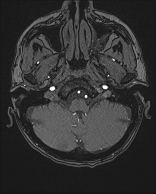 Cerebral embolic infarcts (embolic shower) (Radiopaedia 72391-82921 Axial MRA 6).jpg