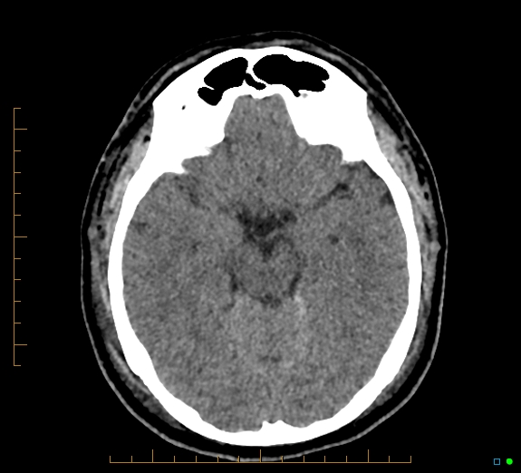 Cerebral fat embolism (Radiopaedia 85521-101224 Axial non-contrast 20).jpg