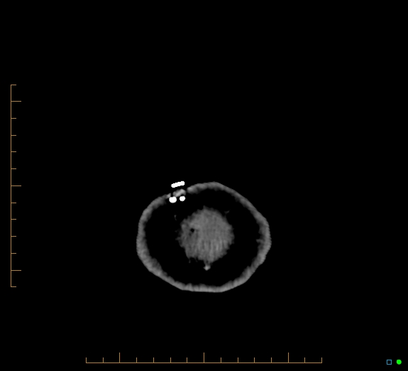 Cerebral fat embolism (Radiopaedia 85521-101224 Axial non-contrast 55).jpg