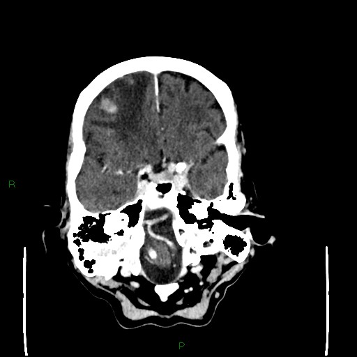 Cerebral metastases - breast primary (Radiopaedia 77653-89857 Axial C+ delayed 31).jpg