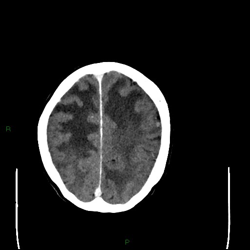 Cerebral metastases - breast primary (Radiopaedia 77653-89857 Axial C+ delayed 87).jpg