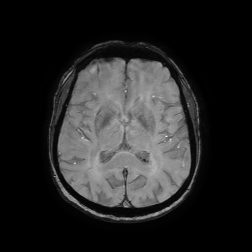 Cerebral metastases - melanoma (Radiopaedia 80972-94522 Axial SWI 54).jpg