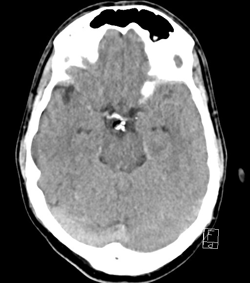 Cerebral metastases - testicular choriocarcinoma (Radiopaedia 84486-99855 Axial non-contrast 36).jpg