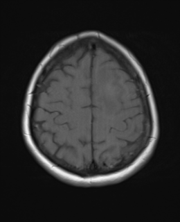 File:Cerebral metastases mimicking abscesses (Radiopaedia 45841-50131 Axial T1 23).png