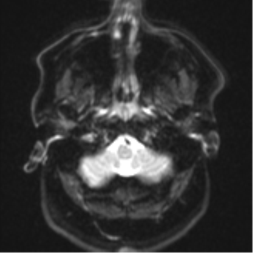 Cerebral metastases mimicking multifocal glioblastoma (Radiopaedia 50843-56353 Axial DWI 3).png