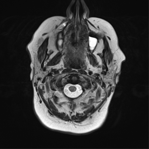 File:Cerebral metastasis mimicking glioblastoma (Radiopaedia 69155-78937 Axial T2 2).png