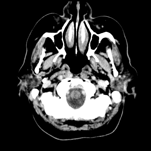 Cerebral metastasis to basal ganglia (Radiopaedia 81568-95412 Axial C+ delayed 9).png