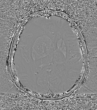 Cerebral metastasis to basal ganglia (Radiopaedia 81568-95413 Axial SWI phase 46).png