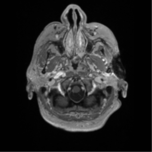 Cerebral metastasis to basal ganglia (Radiopaedia 81568-95413 Axial T1 C+ 4).png