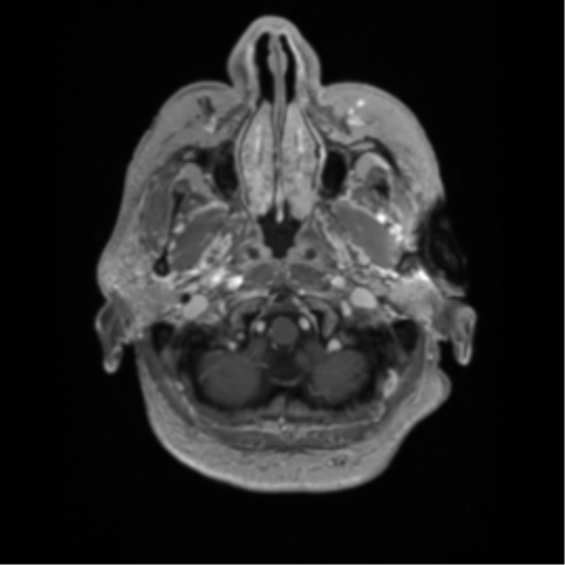 Cerebral metastasis to basal ganglia (Radiopaedia 81568-95413 Axial T1 C+ 5).png