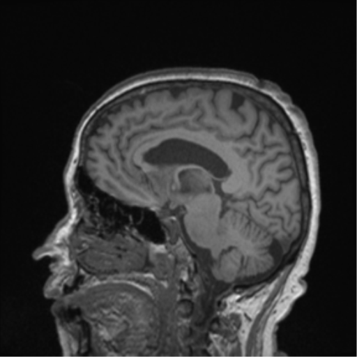 Cerebral metastasis to basal ganglia (Radiopaedia 81568-95413 Sagittal T1 32).png