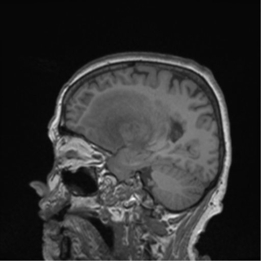 Cerebral metastasis to basal ganglia (Radiopaedia 81568-95413 Sagittal T1 49).png