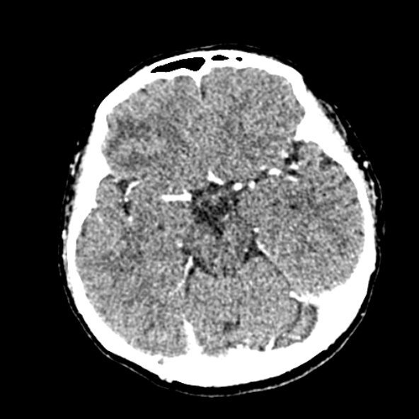 Cerebral ring enhancing lesions - cerebral metastases (Radiopaedia 44922-48818 B 112).jpg