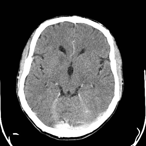File:Cerebral toxoplasmosis (Radiopaedia 43956-47460 Axial C+ delayed 14).jpg