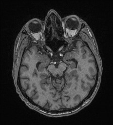 Cerebral toxoplasmosis (Radiopaedia 43956-47461 Axial T1 29).jpg