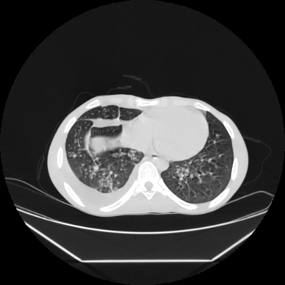 Cerebral tuberculoma (Radiopaedia 80829-94318 Axial lung window 130).jpg