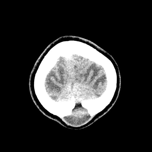 Cerebral tuberculosis with dural sinus invasion (Radiopaedia 60353-68018 Axial non-contrast 59).jpg
