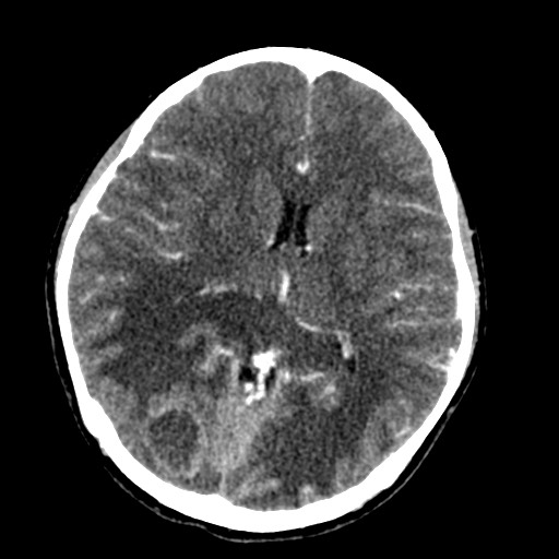 Cerebral tuberculosis with dural sinus invasion (Radiopaedia 60353-68019 Axial C+ delayed 34).jpg