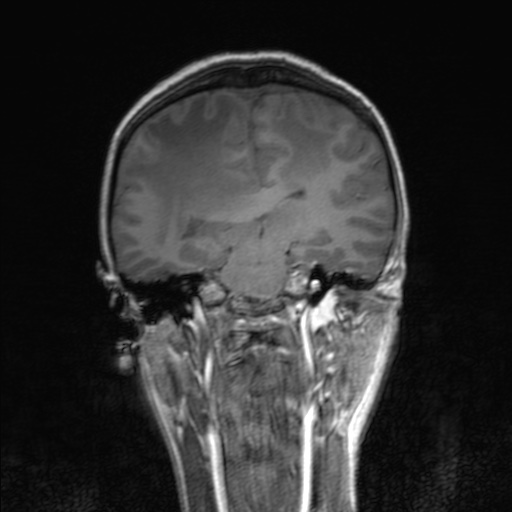Cerebral tuberculosis with dural sinus invasion (Radiopaedia 60353-68090 Coronal T1 108).jpg