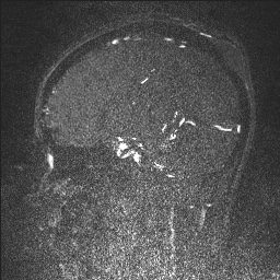 Cerebral tuberculosis with dural sinus invasion (Radiopaedia 60353-68090 Sagittal MRV 64).jpg