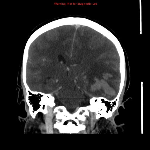 Cerebral venous infarction (Radiopaedia 12404-20735 B 48).jpg