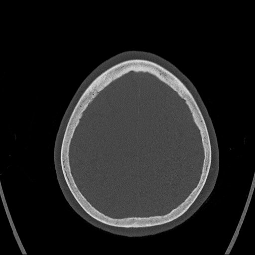 Cerebral venous infarction with hemorrhage (Radiopaedia 65343-74381 Axial bone window 154).jpg