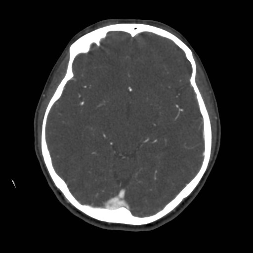 Cerebral venous sinus thrombosis (Radiopaedia 40619-43227 A 100).jpg