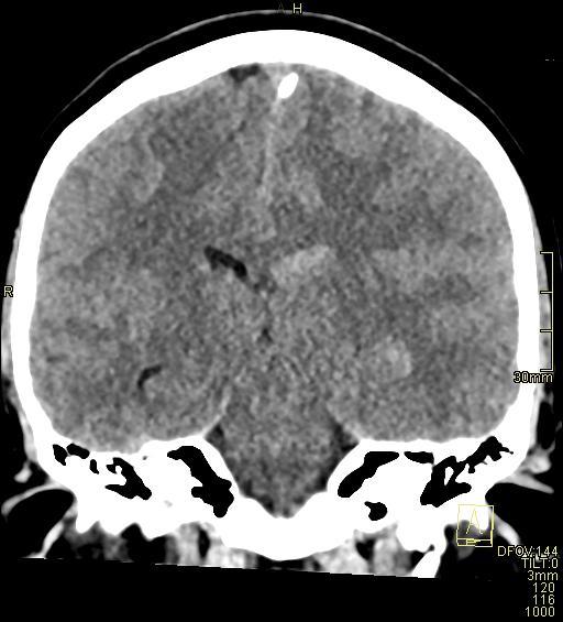 File:Cerebral venous sinus thrombosis (Radiopaedia 91329-108965 Coronal non-contrast 32).jpg