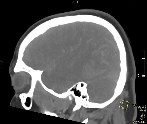 Cerebral venous sinus thrombosis (Radiopaedia 91329-108965 Sagittal venogram 59).jpg