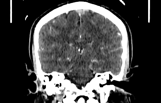 File:Cerebral venous thrombosis (CVT) (Radiopaedia 77524-89685 C 38).jpg
