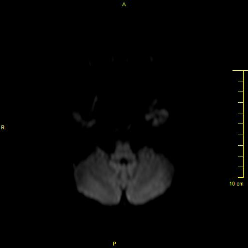 File:Cerebral venous thrombosis (Radiopaedia 23288-23351 Axial DWI 5).JPG
